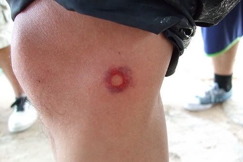 Rubber Bullet Injuries