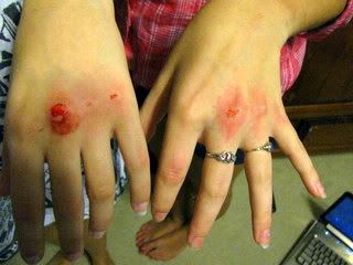 Bloody Knuckles